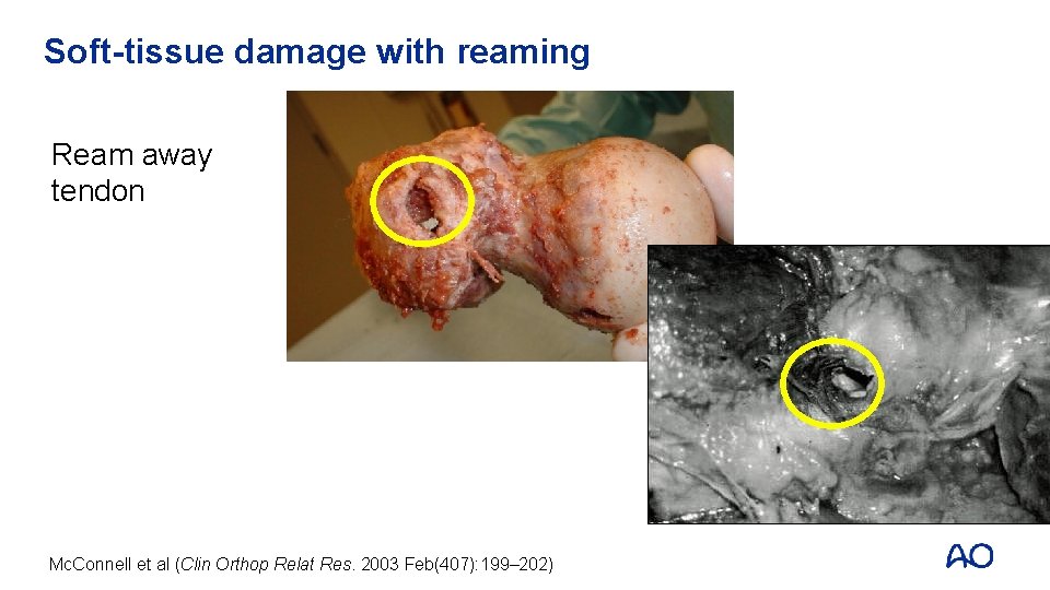 Soft-tissue damage with reaming Ream away tendon Mc. Connell et al (Clin Orthop Relat