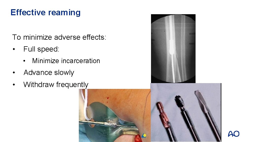 Effective reaming To minimize adverse effects: • Full speed: • Minimize incarceration • Advance