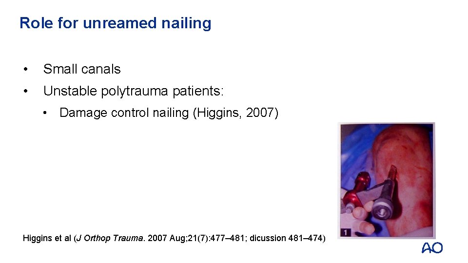 Role for unreamed nailing • Small canals • Unstable polytrauma patients: • Damage control