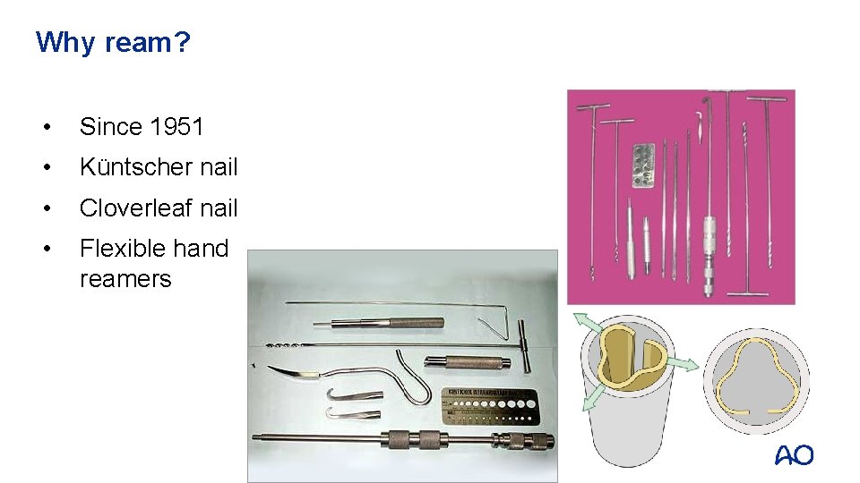 Why ream? • Since 1951 • Küntscher nail • Cloverleaf nail • Flexible hand