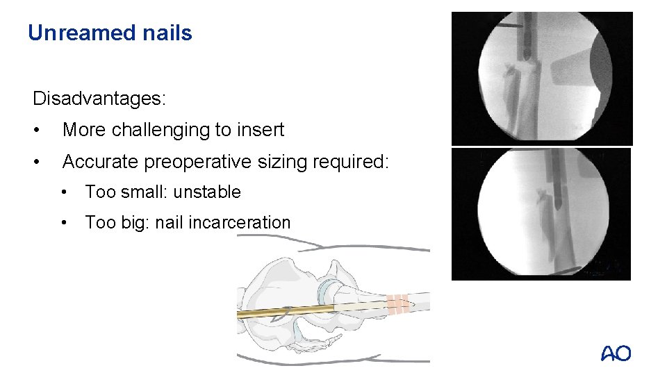 Unreamed nails Disadvantages: • More challenging to insert • Accurate preoperative sizing required: •
