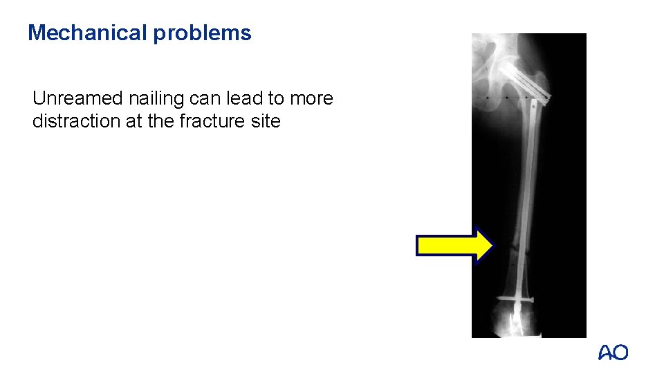 Mechanical problems Unreamed nailing can lead to more distraction at the fracture site 