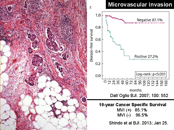 Microvascular invasion Dall´Oglio BJI. 2007; 100: 552 10 -year Cancer Specific Survival MVI (+) Microvascular invasion Dall´Oglio BJI. 2007; 100: 552 10 -year Cancer Specific Survival MVI (+)