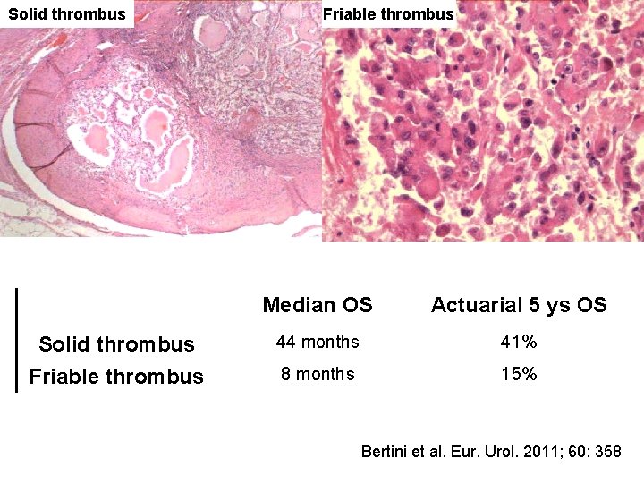 Solid thrombus Friable thrombus Median OS Actuarial 5 ys OS 44 months 41% 8 Solid thrombus Friable thrombus Median OS Actuarial 5 ys OS 44 months 41% 8