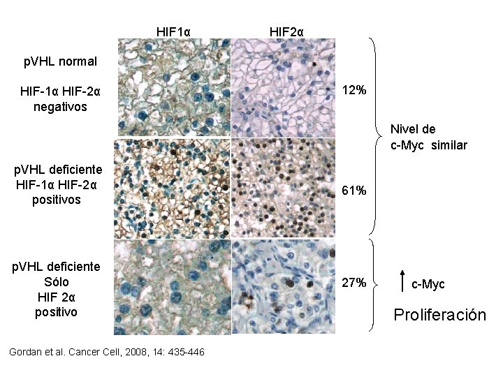 HIF 1α HIF 2α p. VHL normal HIF-1α HIF-2α negativos 12% Nivel de c-Myc HIF 1α HIF 2α p. VHL normal HIF-1α HIF-2α negativos 12% Nivel de c-Myc