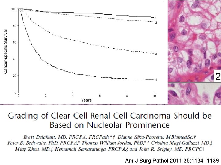 400 x 1 3 2 4 Am J Surg Pathol 2011; 35: 1134– 1139 400 x 1 3 2 4 Am J Surg Pathol 2011; 35: 1134– 1139