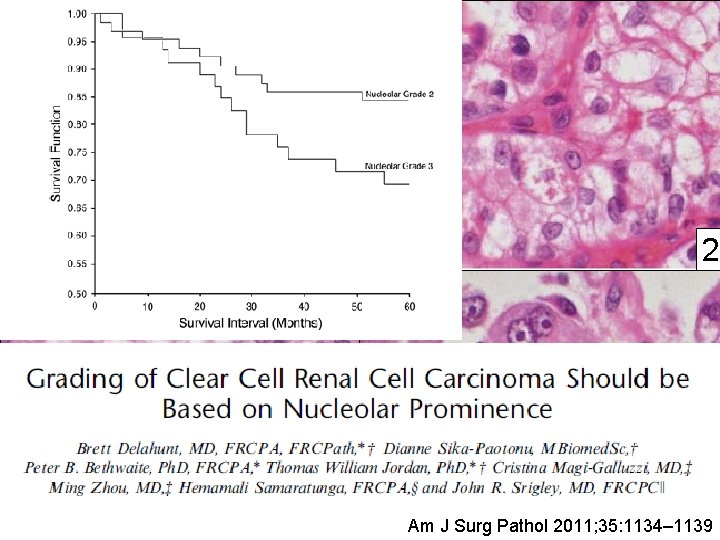 400 x 1 3 2 4 Am J Surg Pathol 2011; 35: 1134– 1139 400 x 1 3 2 4 Am J Surg Pathol 2011; 35: 1134– 1139