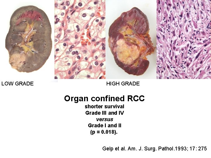 LOW GRADE HIGH GRADE Organ confined RCC shorter survival Grade III and IV versus LOW GRADE HIGH GRADE Organ confined RCC shorter survival Grade III and IV versus