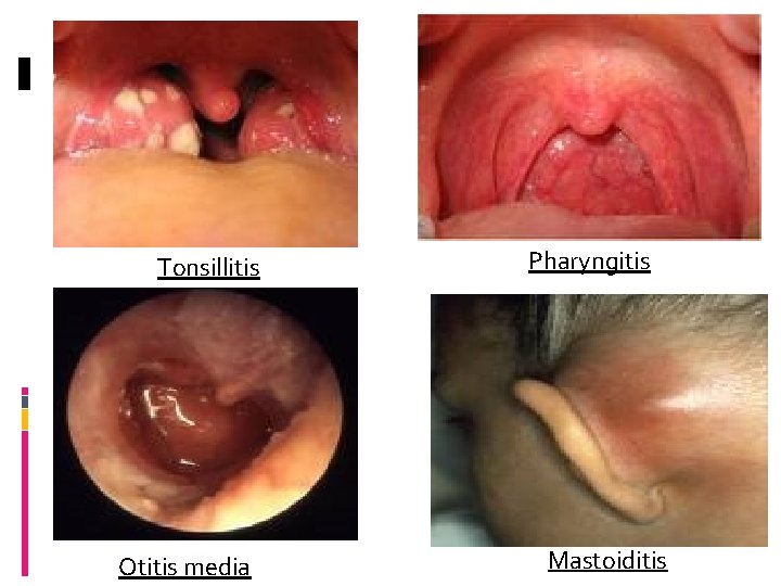 Tonsillitis Otitis media Pharyngitis Mastoiditis 