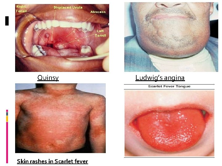 Quinsy Skin rashes in Scarlet fever Ludwig’s angina 