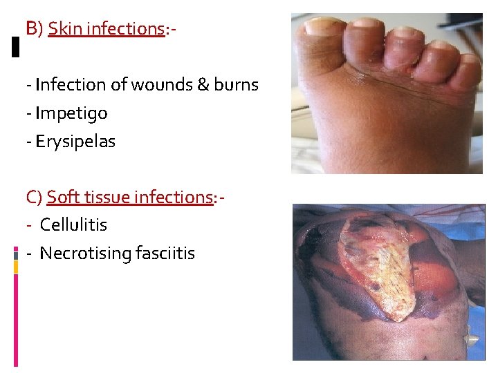 B) Skin infections: - Infection of wounds & burns - Impetigo - Erysipelas C)