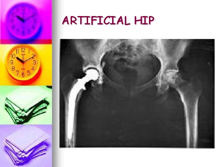 ARTIFICIAL HIP ARTIFICIAL HIP