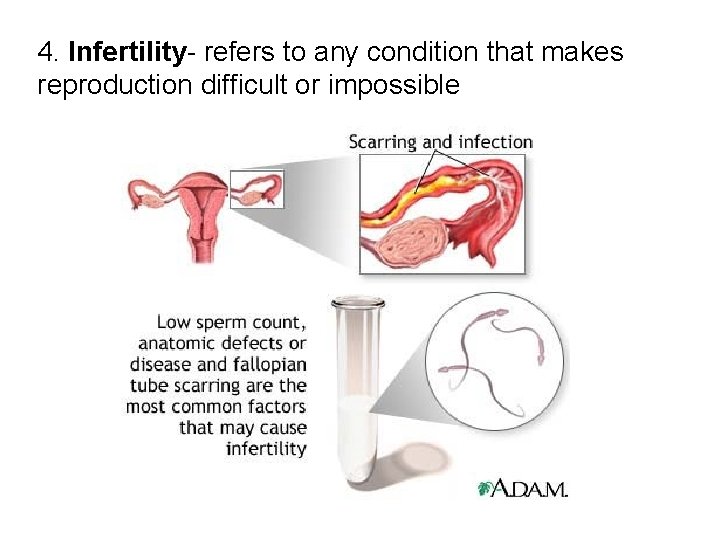 4. Infertility- refers to any condition that makes reproduction difficult or impossible 