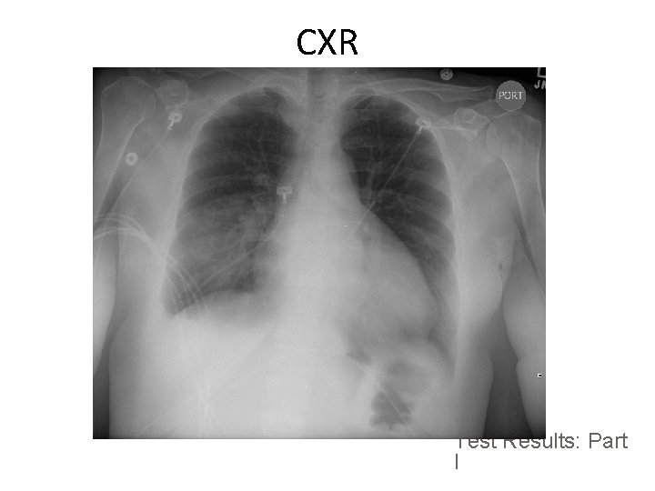 Testing Cxr Slide Sets 1 1 Early Goal Directed Therapy