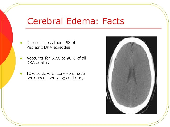Cerebral Edema: Facts l Occurs in less than 1% of Pediatric DKA episodes l