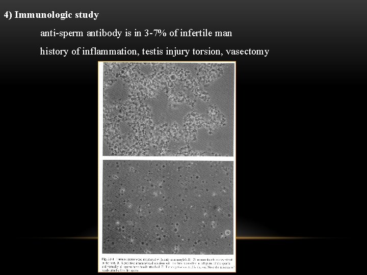 4) Immunologic study anti-sperm antibody is in 3 -7% of infertile man history of