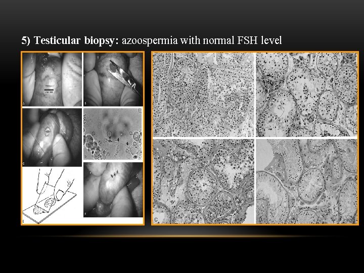  5) Testicular biopsy: azoospermia with normal FSH level 