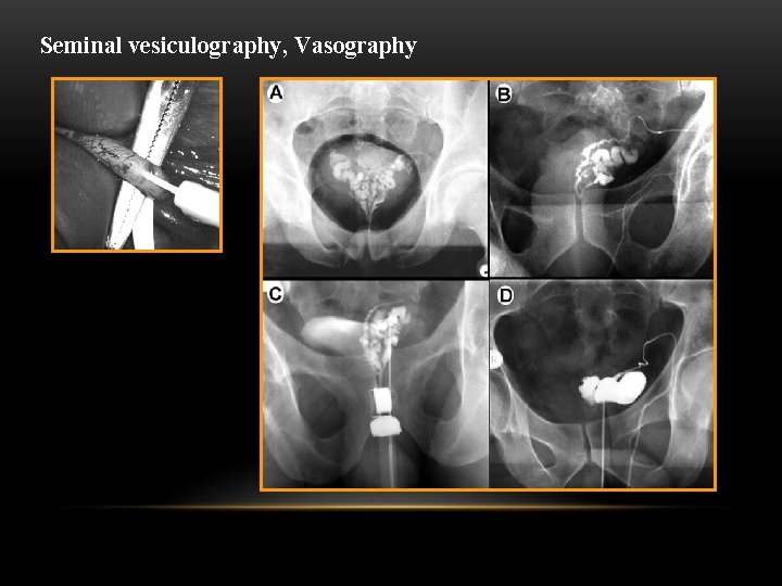 Seminal vesiculography, Vasography 