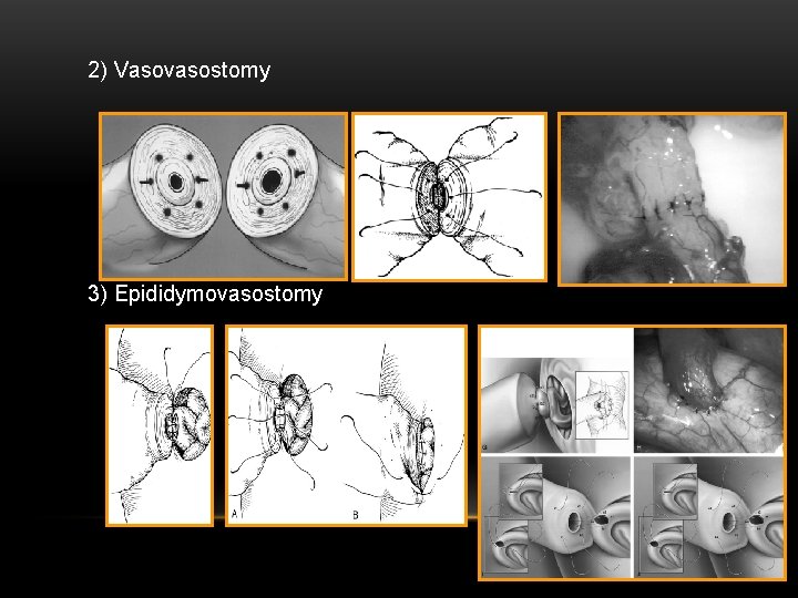  2) Vasovasostomy 3) Epididymovasostomy 