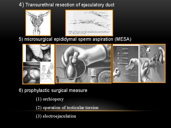 4) Transurethral resection of ejaculatory duct 5) microsurgical epididymal sperm aspiration (MESA) 6) prophylactic
