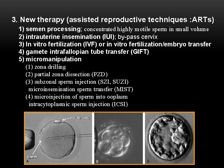 3. New therapy (assisted reproductive techniques : ARTs) 1) semen processing; concentrated highly motile