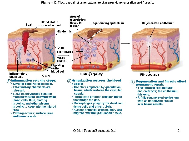 Figure 4. 12 Tissue repair of a nonextensive skin wound: regeneration and fibrosis. Scab