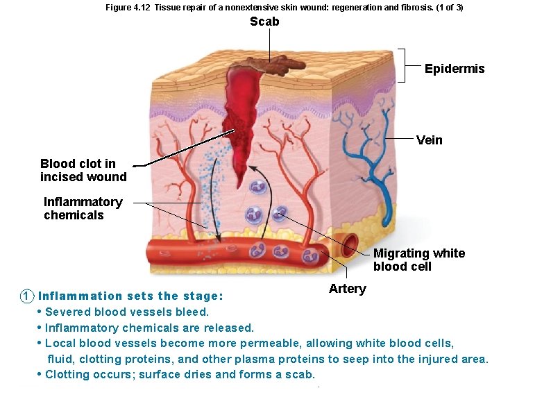 Figure 4. 12 Tissue repair of a nonextensive skin wound: regeneration and fibrosis. (1