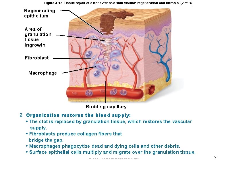 Figure 4. 12 Tissue repair of a nonextensive skin wound: regeneration and fibrosis. (2