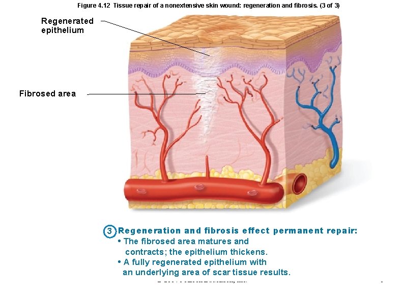 Figure 4. 12 Tissue repair of a nonextensive skin wound: regeneration and fibrosis. (3