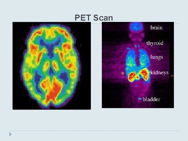 PET Scan 