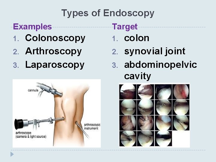 Types of Endoscopy Examples 1. 2. 3. Colonoscopy Arthroscopy Laparoscopy Target 1. 2. 3.