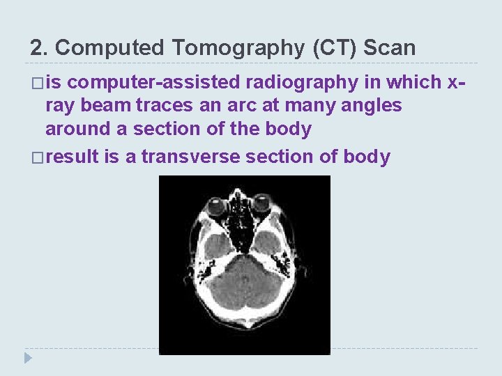 2. Computed Tomography (CT) Scan �is computer-assisted radiography in which xray beam traces an