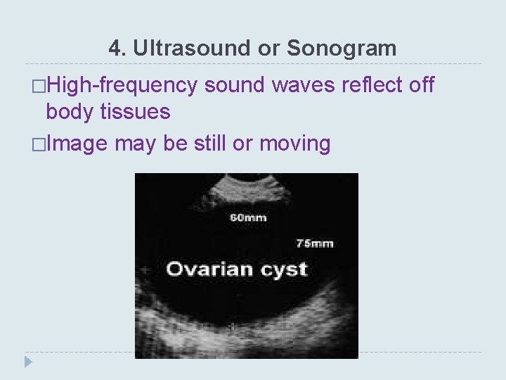 4. Ultrasound or Sonogram �High-frequency sound waves reflect off body tissues �Image may be