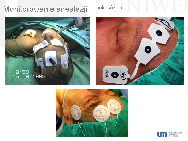 Monitorowanie anestezji głębokość snu 