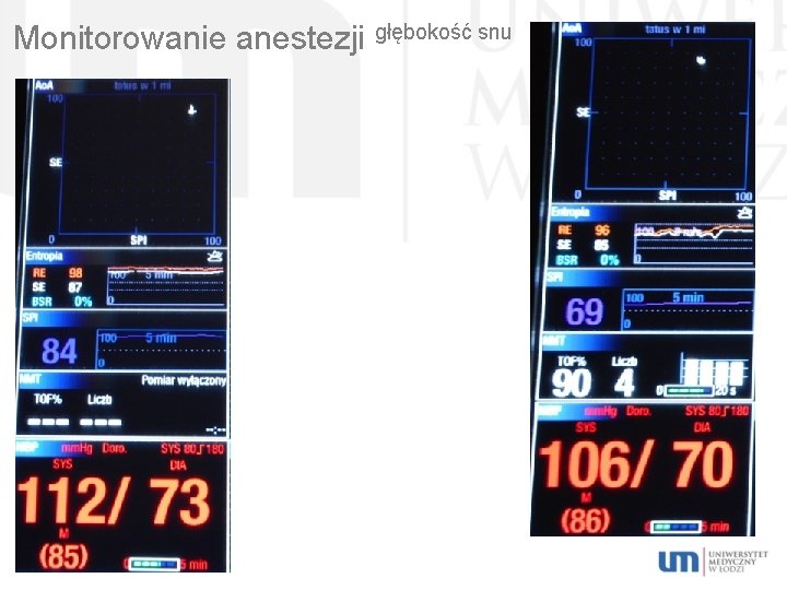 Monitorowanie anestezji głębokość snu 