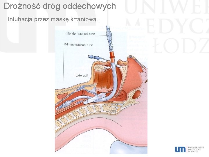 Drożność dróg oddechowych Intubacja przez maskę krtaniową. 