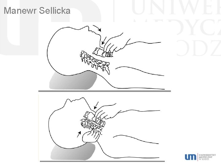Manewr Sellicka 