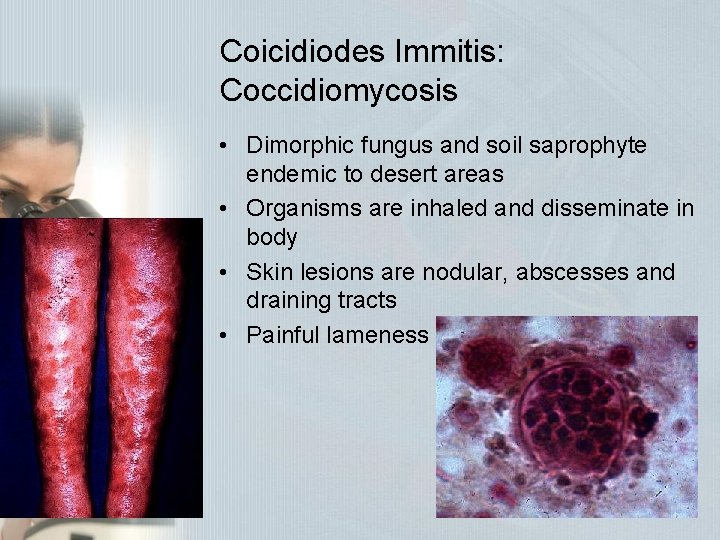 Coicidiodes Immitis: Coccidiomycosis • Dimorphic fungus and soil saprophyte endemic to desert areas • Coicidiodes Immitis: Coccidiomycosis • Dimorphic fungus and soil saprophyte endemic to desert areas •