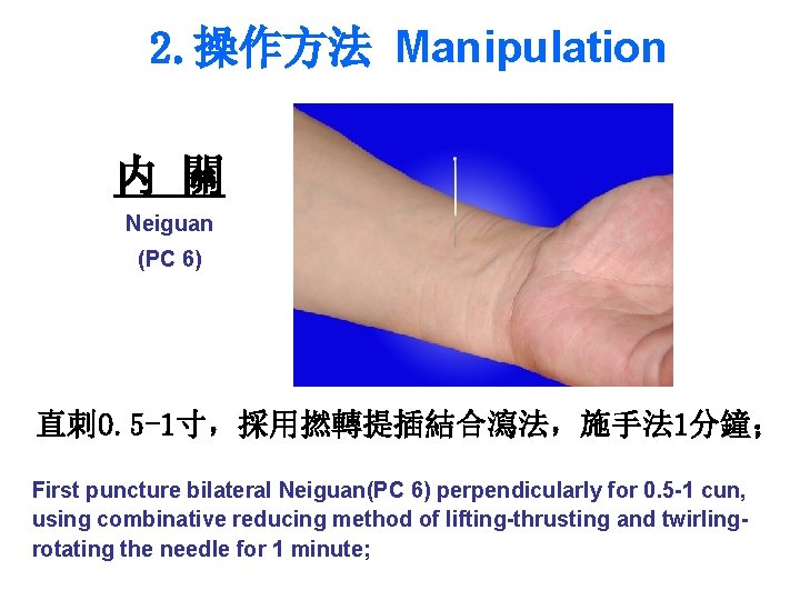2. 操作方法 Manipulation 内 關 Neiguan (PC 6) 直刺 0. 5 -1寸，採用撚轉提插結合瀉法，施手法 1分鐘； First