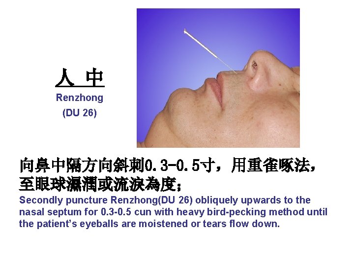 人 中 Renzhong (DU 26) 向鼻中隔方向斜刺 0. 3 -0. 5寸，用重雀啄法， 至眼球濕潤或流淚為度； Secondly puncture Renzhong(DU