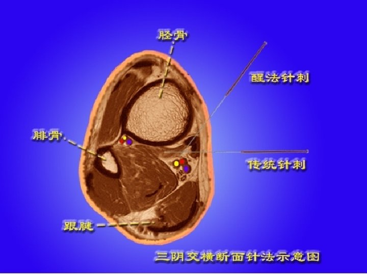 三 陰 交 Sanyinjiao (SP 6) 沿脛骨內側緣與皮膚呈45度角斜刺，進針 1~1. 5，用提 插補法，使患側下肢抽動 3次為度 Thirdly puncture Sanyinjiao(SP