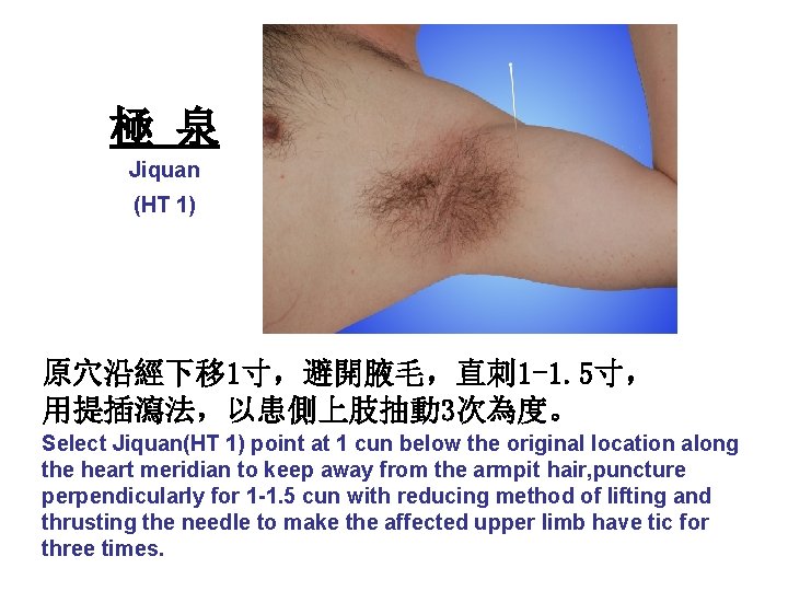 極 泉 Jiquan (HT 1) 原穴沿經下移 1寸，避開腋毛，直刺 1 -1. 5寸， 用提插瀉法，以患側上肢抽動 3次為度。 Select Jiquan(HT