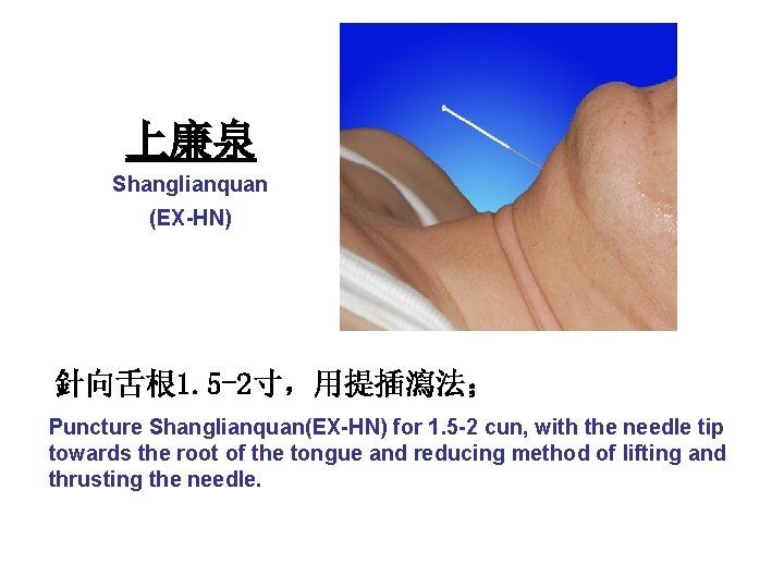 上廉泉 Shanglianquan (EX-HN) 針向舌根 1. 5 -2寸，用提插瀉法； Puncture Shanglianquan(EX-HN) for 1. 5 -2 cun,