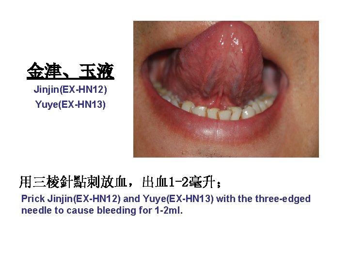 金津、玉液 Jinjin(EX-HN 12) Yuye(EX-HN 13) 用三棱針點刺放血，出血1 -2毫升； Prick Jinjin(EX-HN 12) and Yuye(EX-HN 13) with