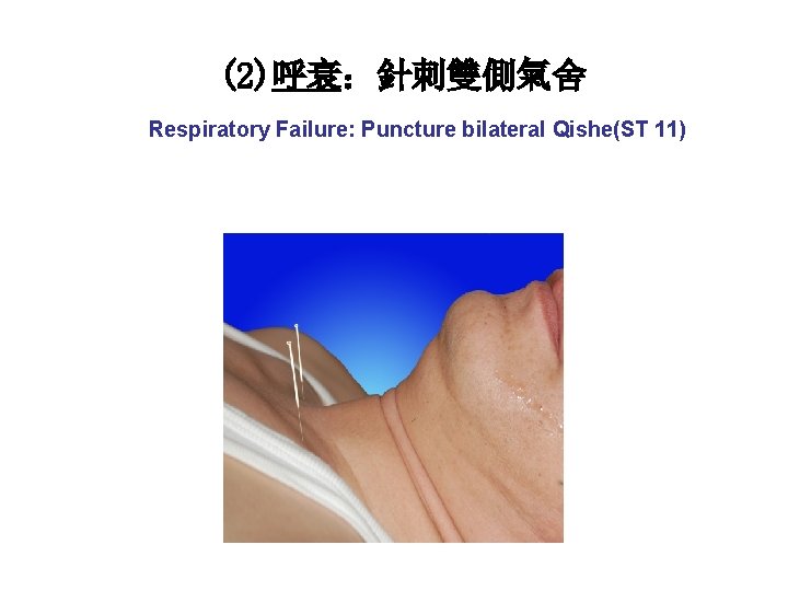 (2)呼衰：針刺雙側氣舍 Respiratory Failure: Puncture bilateral Qishe(ST 11) 