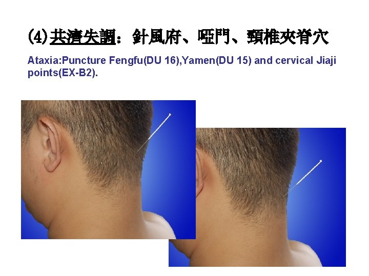 (4)共濟失調：針風府、啞門、頸椎夾脊穴 Ataxia: Puncture Fengfu(DU 16), Yamen(DU 15) and cervical Jiaji points(EX-B 2). 