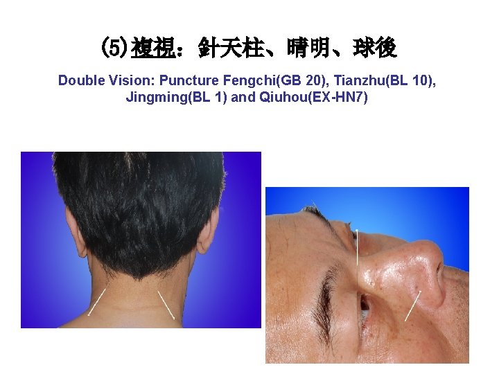 (5)複視：針天柱、晴明、球後 Double Vision: Puncture Fengchi(GB 20), Tianzhu(BL 10), Jingming(BL 1) and Qiuhou(EX-HN 7) 
