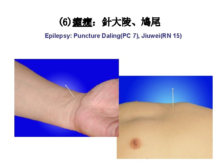 (6)癲癇：針大陵、鳩尾 Epilepsy: Puncture Daling(PC 7), Jiuwei(RN 15) 