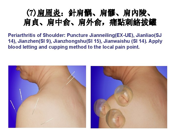 (7)肩周炎：針肩髃、肩髎、肩內陵、 肩貞、肩中俞、肩外俞，痛點刺絡拔罐 Periarthritis of Shoulder: Puncture Jianneiling(EX-UE), Jianliao(SJ 14), Jianzhen(SI 9), Jianzhongshu(SI 15), Jianwaishu