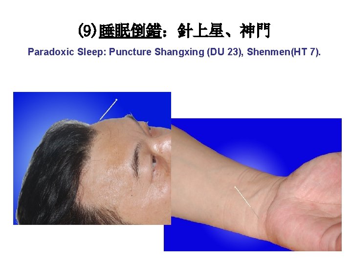 (9)睡眠倒錯：針上星、神門 Paradoxic Sleep: Puncture Shangxing (DU 23), Shenmen(HT 7). 